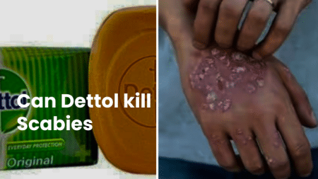 Can Dettol kill Scabies