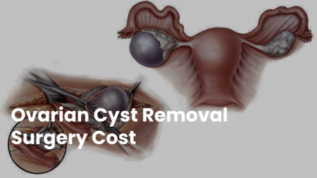 Ovarian Cyst Removal Surgery Cost